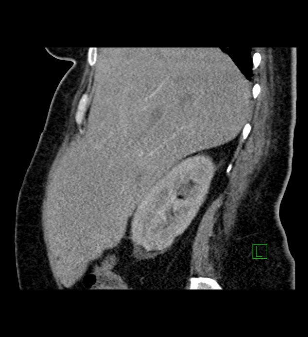 Chromophobe renal cell carcinoma (Radiopaedia 84239-99519 D 88).jpg