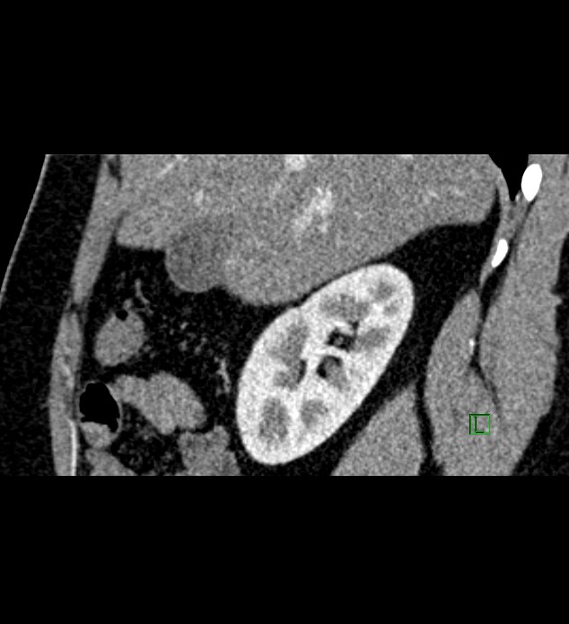Chromophobe renal cell carcinoma (Radiopaedia 84286-99573 F 124).jpg