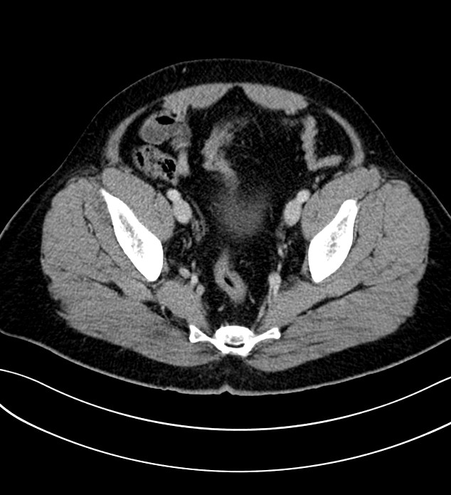 Chromophobe renal cell carcinoma (Radiopaedia 84286-99573 G 62).jpg