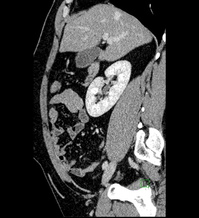 Chromophobe renal cell carcinoma (Radiopaedia 84286-99573 I 122).jpg