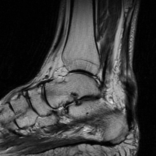 File:Chronic Achilles tendon rupture (Radiopaedia 15262-15100 Sagittal T2 8).jpg