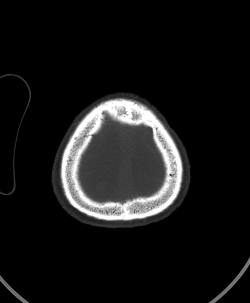 Chronic bilateral subdural hygroma (Radiopaedia 85801-101623 Axial bone window 19).jpg
