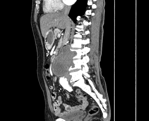 File:Chronic contained rupture of abdominal aortic aneurysm with extensive erosion of the vertebral bodies (Radiopaedia 55450-61901 B 22).jpg