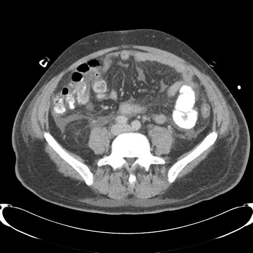 Chronic diverticulitis complicated by hepatic abscess and portal vein thrombosis (Radiopaedia 30301-30938 A 61).jpg