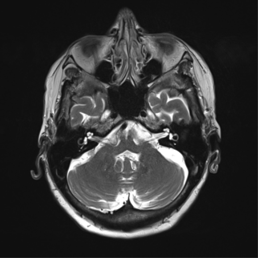 File:Chronic hypertensive encephalopathy (Radiopaedia 39993-42482 Axial T2 9).png