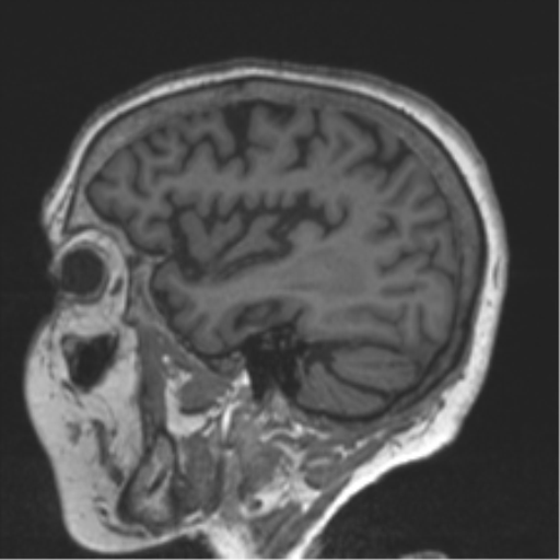 Chronic hypertensive encephalopathy (Radiopaedia 39993-42482 Sagittal T1 27).png