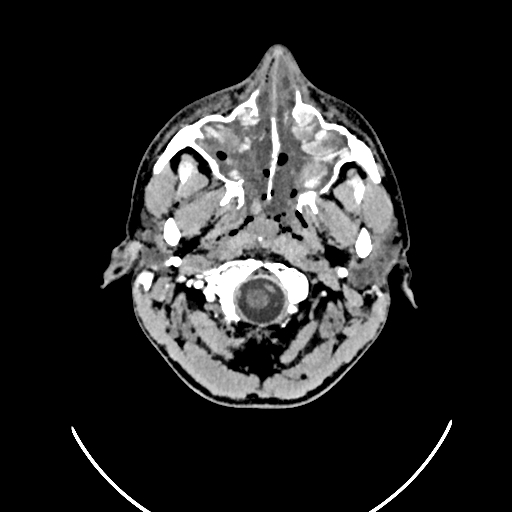 Chronic invasive fungal sinusitis (Radiopaedia 50342-55710 Axial non-contrast 16).jpg