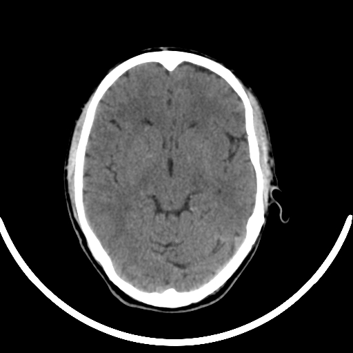 Chronic invasive fungal sinusitis with intraorbital and intracranial extension (Radiopaedia 56387-63046 Axial non-contrast 185).jpg