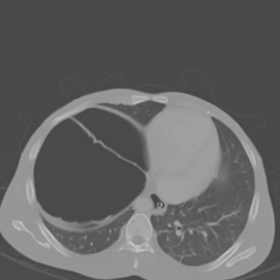 File:Chronic large bowel pseudo-obstruction (Radiopaedia 43181-46492 Axial bone window 27).jpg