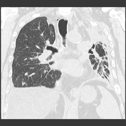Chronic lung allograft dysfunction - restrictive form (Radiopaedia 60595-68316 Coronal lung window 60).jpg
