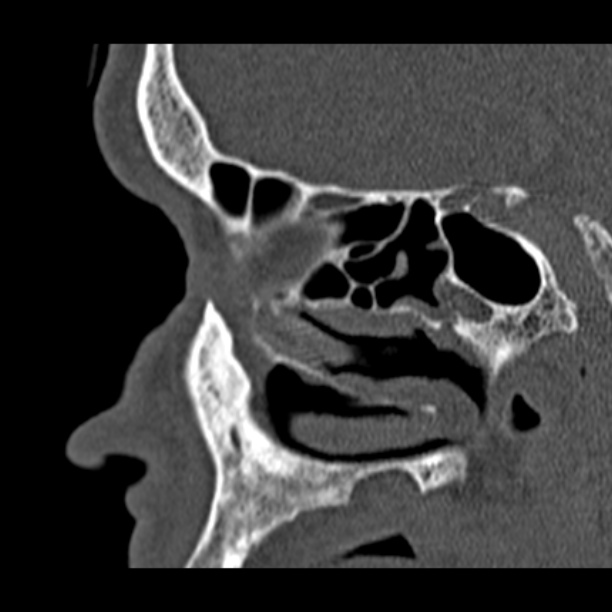 Chronic maxillary sinusitis (Radiopaedia 27879-28116 Sagittal bone window 36).jpg