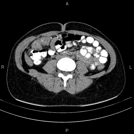 File:Chronic pancreatitis (Radiopaedia 64576-73450 Axial non-contrast 97).jpg