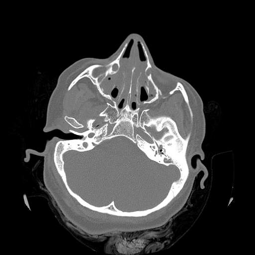 Chronic sinusitis with intra-sinus calcification (Radiopaedia 63919-72668 Axial bone window 40).jpg