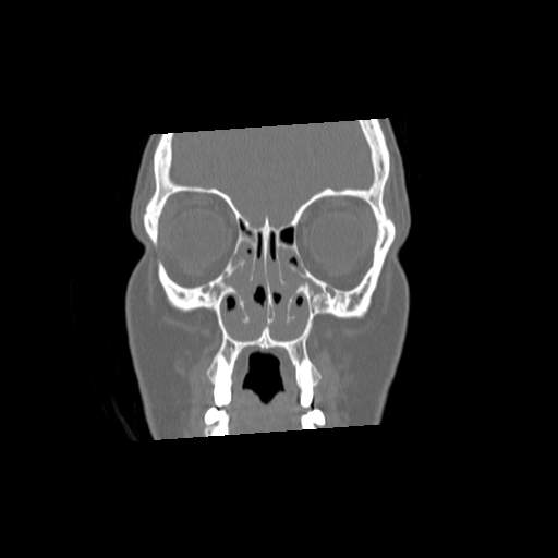 File:Chronic sinusitis with intra-sinus calcification (Radiopaedia 63919-72668 Coronal bone window 9).jpg