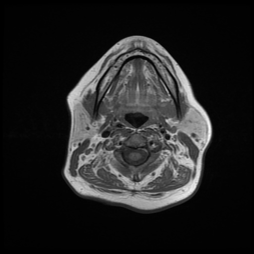 File:Chronic submandibular sialadenitis (Radiopaedia 61852-69885 Axial T1 13).jpg
