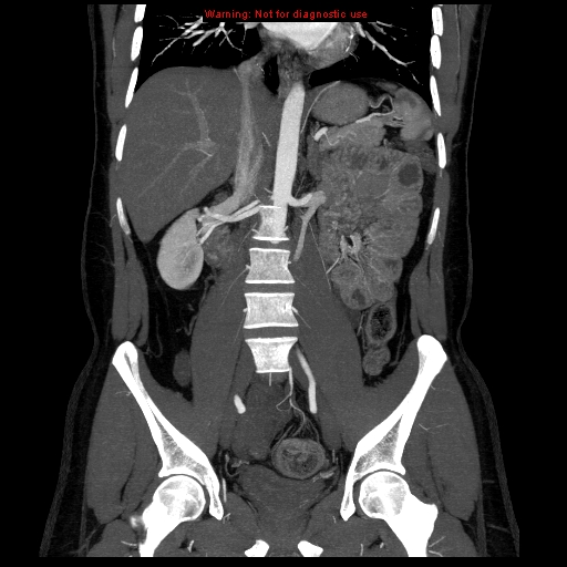 File:Circumaortic left renal vein (Radiopaedia 9069-9792 B 19).jpg