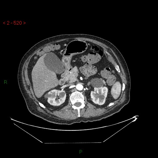 Circumaortic left renal vein and doubled left renal arteries (Radiopaedia 52268-58158 A 56).jpg