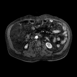 Cirrhosis and hepatocellular carcinoma in the setting of hemochromatosis (Radiopaedia 75394-86594 Axial T1 C+ fat sat 92).jpg