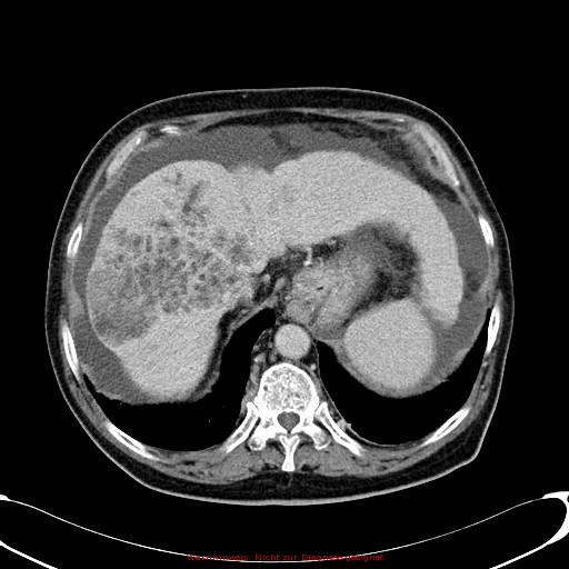Cirrhosis and hepatocellular carcinoma in the setting of hemochromatosis (Radiopaedia 75394-86595 B 22).jpg