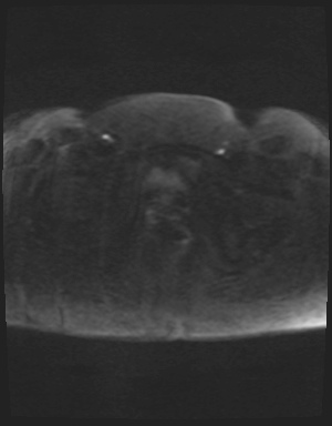 File:Class II Mullerian duct anomaly- unicornuate uterus with rudimentary horn and non-communicating cavity (Radiopaedia 39441-41755 Axial DWI 88).jpg