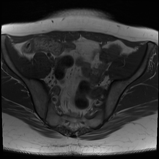 File:Class II Mullerian duct anomaly- unicornuate uterus with rudimentary horn and non-communicating cavity (Radiopaedia 39441-41755 Axial T1 10).jpg