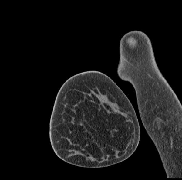 Clear cell chondrosarcoma - humerus (Radiopaedia 63104-71612 D 3).jpg