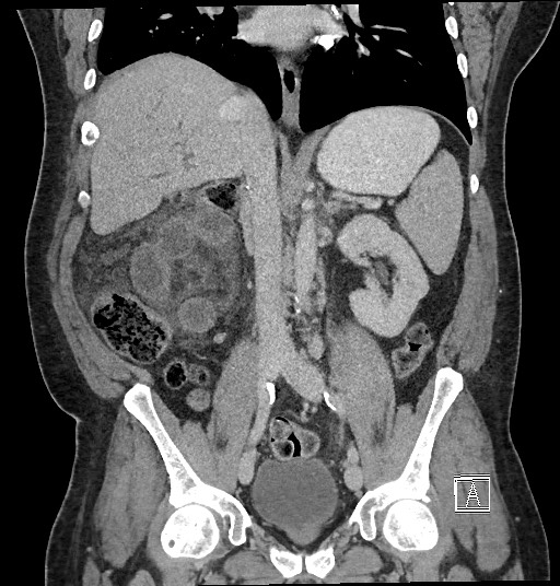 File:Closed loop obstruction - internal hernia into nephrectomy bed (Radiopaedia 59867-67320 B 77).jpg