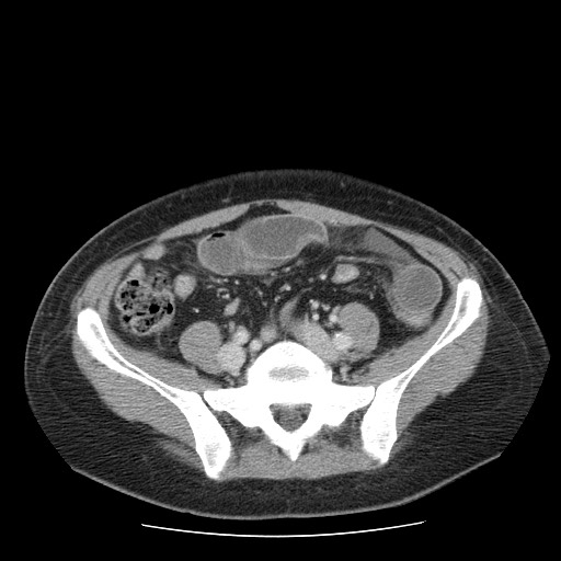 File:Closed loop small bowel obstruction (Radiopaedia 65403-74451 Axial 18).jpg