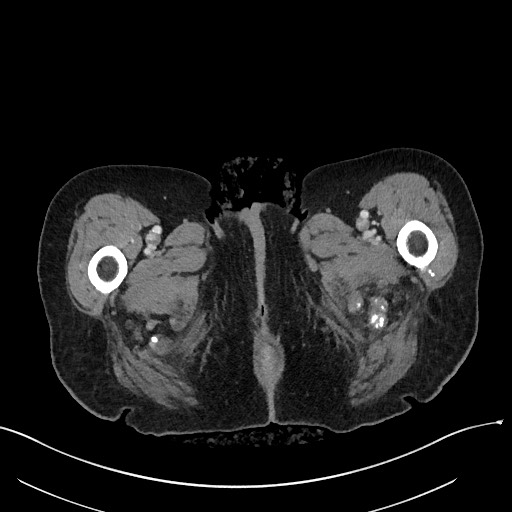 Closed loop small bowel obstruction - adhesions (Radiopaedia 59269-66611 A 153).jpg