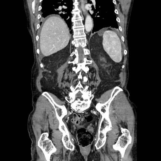 File:Closed loop small bowel obstruction - adhesive disease and hemorrhagic ischemia (Radiopaedia 86831-102990 B 94).jpg