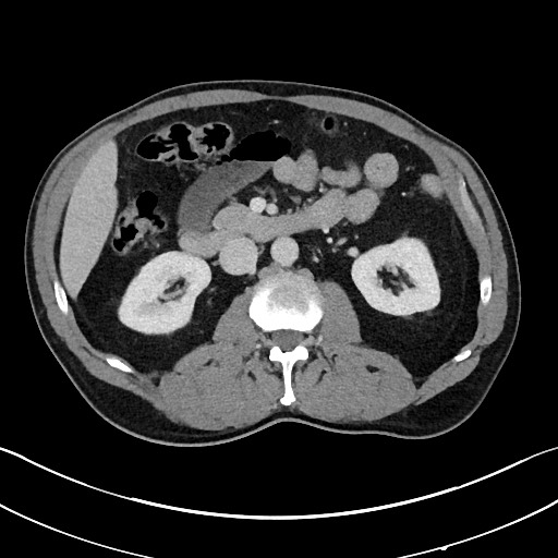 Closed loop small bowel obstruction - internal hernia (Radiopaedia 57806-64778 B 50).jpg