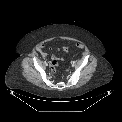Closed loop small bowel obstruction - internal hernia (Radiopaedia 65402-74450 A 106).jpg