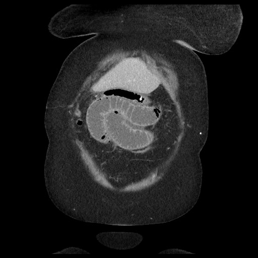 Closed loop small bowel obstruction - internal hernia (Radiopaedia 65402-74450 B 17).jpg