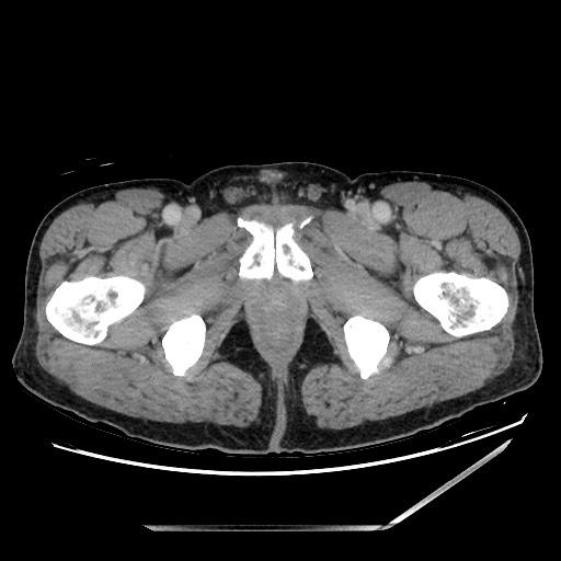 Closed loop small bowel obstruction - omental adhesion causing "internal hernia" (Radiopaedia 85129-100682 A 177).jpg