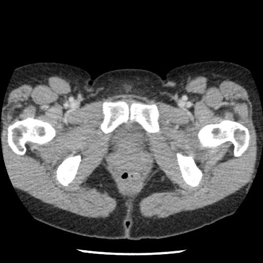 Closed loop small bowel obstruction due to trans-omental herniation (Radiopaedia 35593-37109 A 87).jpg