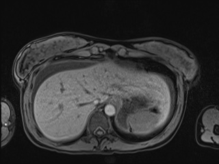 Closed loop small bowel obstruction in pregnancy (MRI) (Radiopaedia 87637-104031 Axial T1 fat sat 20).jpg