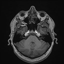 Cochlear incomplete partition type III associated with hypothalamic hamartoma (Radiopaedia 88756-105498 Axial T1 61).jpg