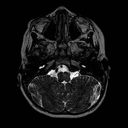 File:Cochlear nerve aplasia - unilateral (Radiopaedia 87910-104413 Axial T2 9).jpg