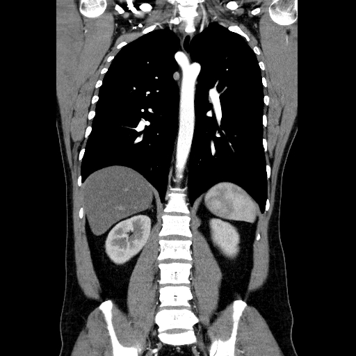 File:Codominant double aortic arch (Radiopaedia 56012-62637 B 31).jpg
