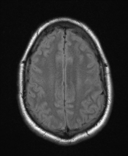 File:Colloid cyst (Radiopaedia 44510-48181 Axial FLAIR 22).png