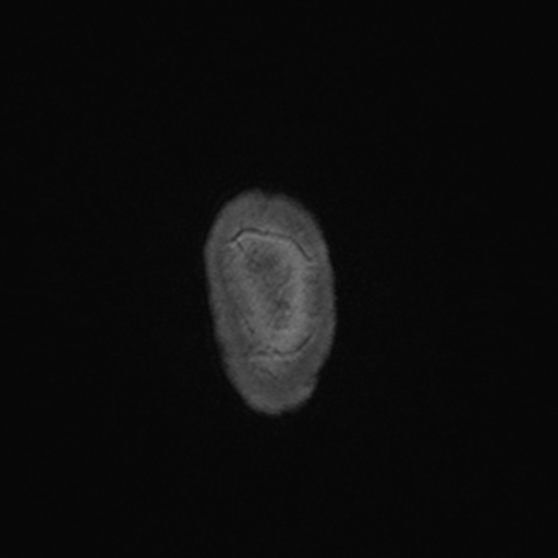 File:Colloid cyst (Radiopaedia 44510-48181 Axial T1 C+ 180).png