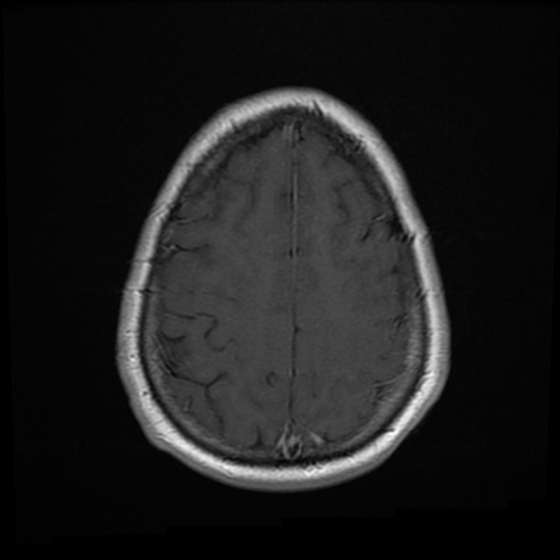 File:Colloid cyst with anterior communicating artery aneurysm (Radiopaedia 33901-35091 Axial T1 23).jpg