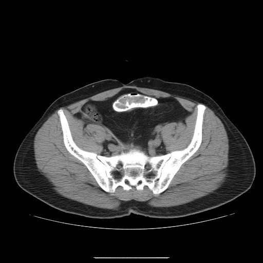 File:Colocutaneous fistula in Crohn's disease (Radiopaedia 29586-30093 D 28).jpg