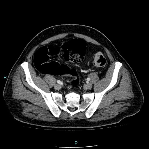 Colon adenocarcinoma with calcific liver metastasis (Radiopaedia 55745-62300 B 35).jpg