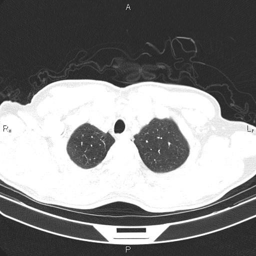 File:Colon cancer (Radiopaedia 85663-101443 Axial lung window 8).jpg