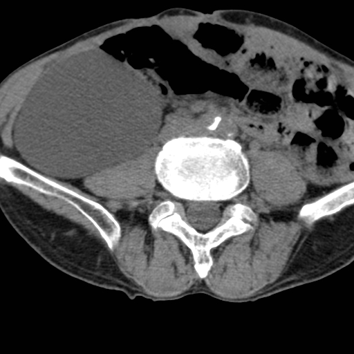Colon cancer with calcified liver metastasis (Radiopaedia 74423-85309 Axial non-contrast 66).jpg