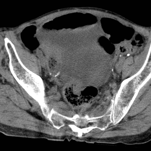 Colon cancer with calcified liver metastasis (Radiopaedia 74423-85309 Axial non-contrast 95).jpg