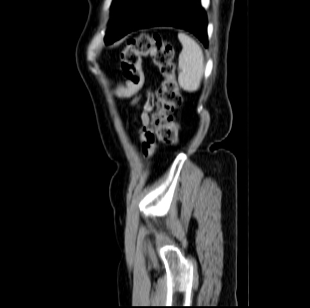 Colon carcinoma with hepatic metastases (Radiopaedia 29477-29961 C 50).jpg