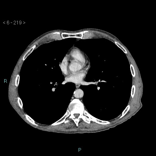 Colonic cancer (ultrasound and TC imaging) (Radiopaedia 50346-55713 B 219).jpg