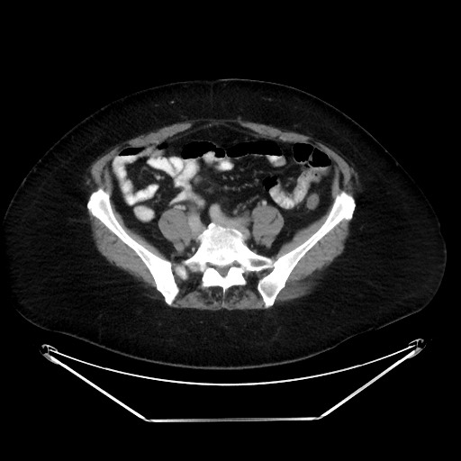 File:Colonic intussusception due to adenocarcinoma (Radiopaedia 86828-102987 A 104).jpg